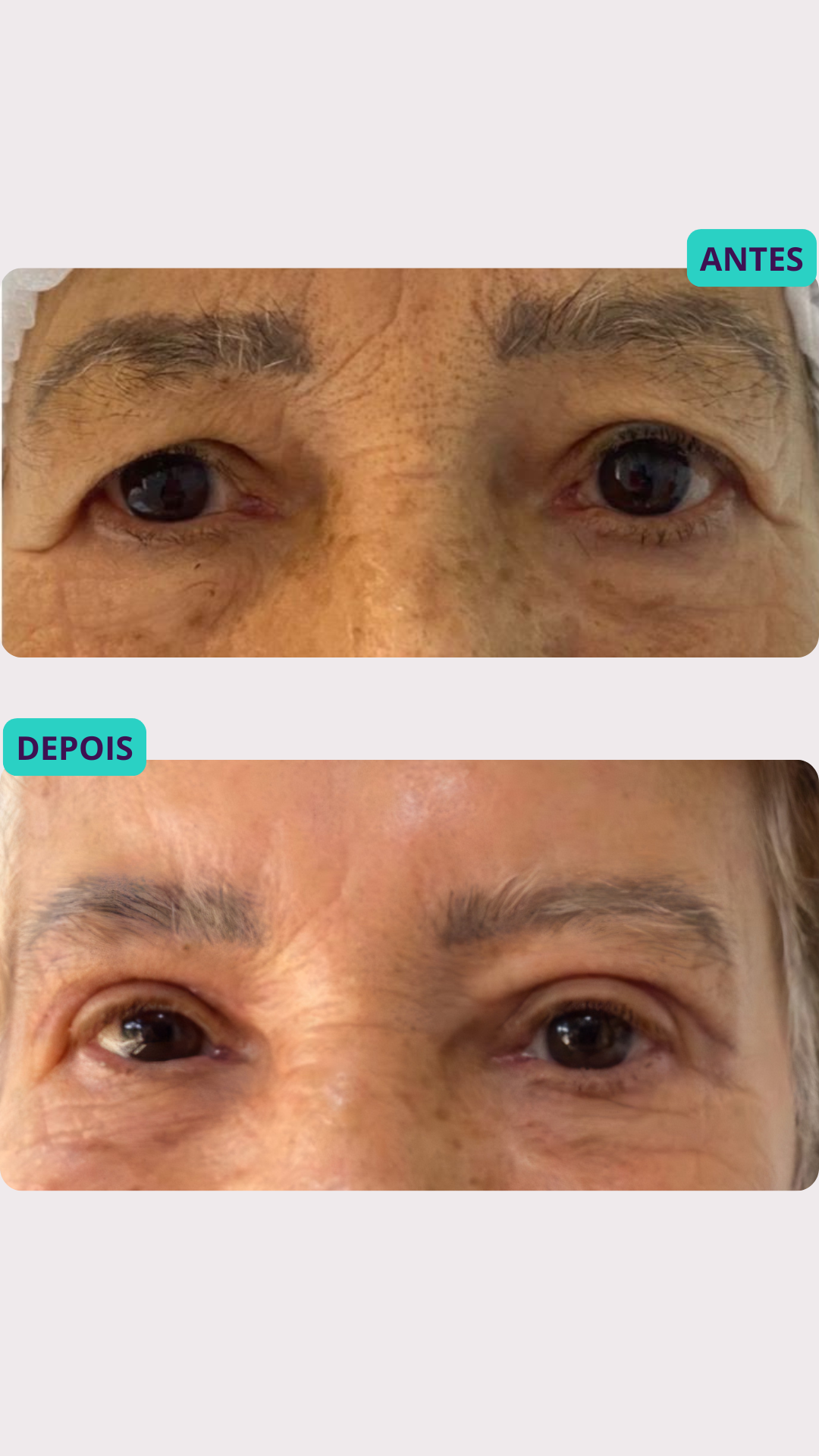 Blefaroplastia a Laser — antes e depois, paciente 1