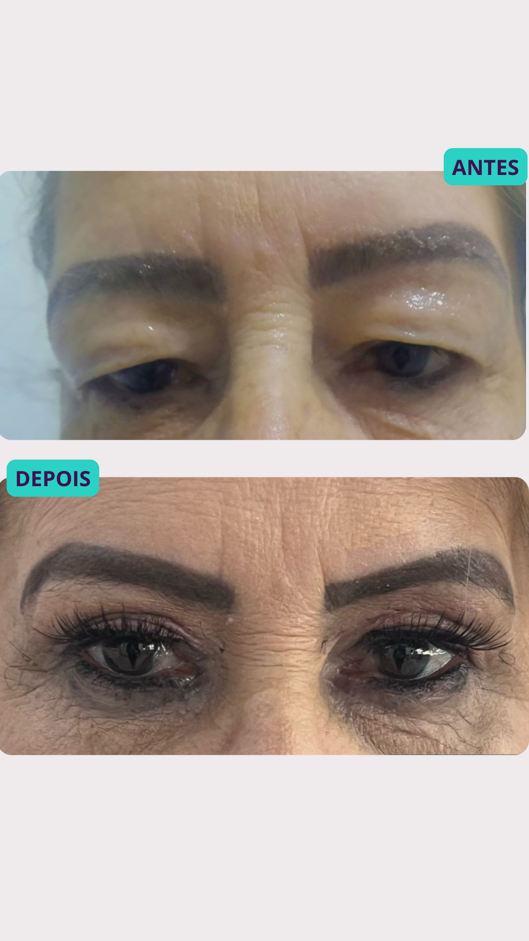 Blefaroplastia a Laser — antes e depois, paciente 2