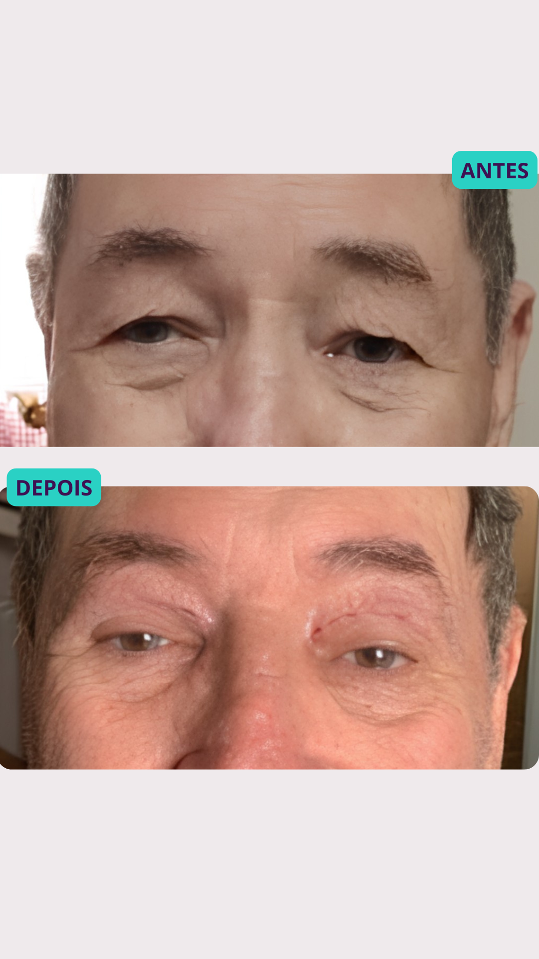 Blefaroplastia a Laser — antes e depois, paciente 3