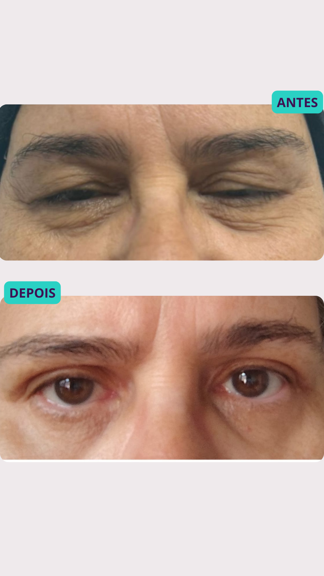 Blefaroplastia a Laser — antes e depois, paciente 4