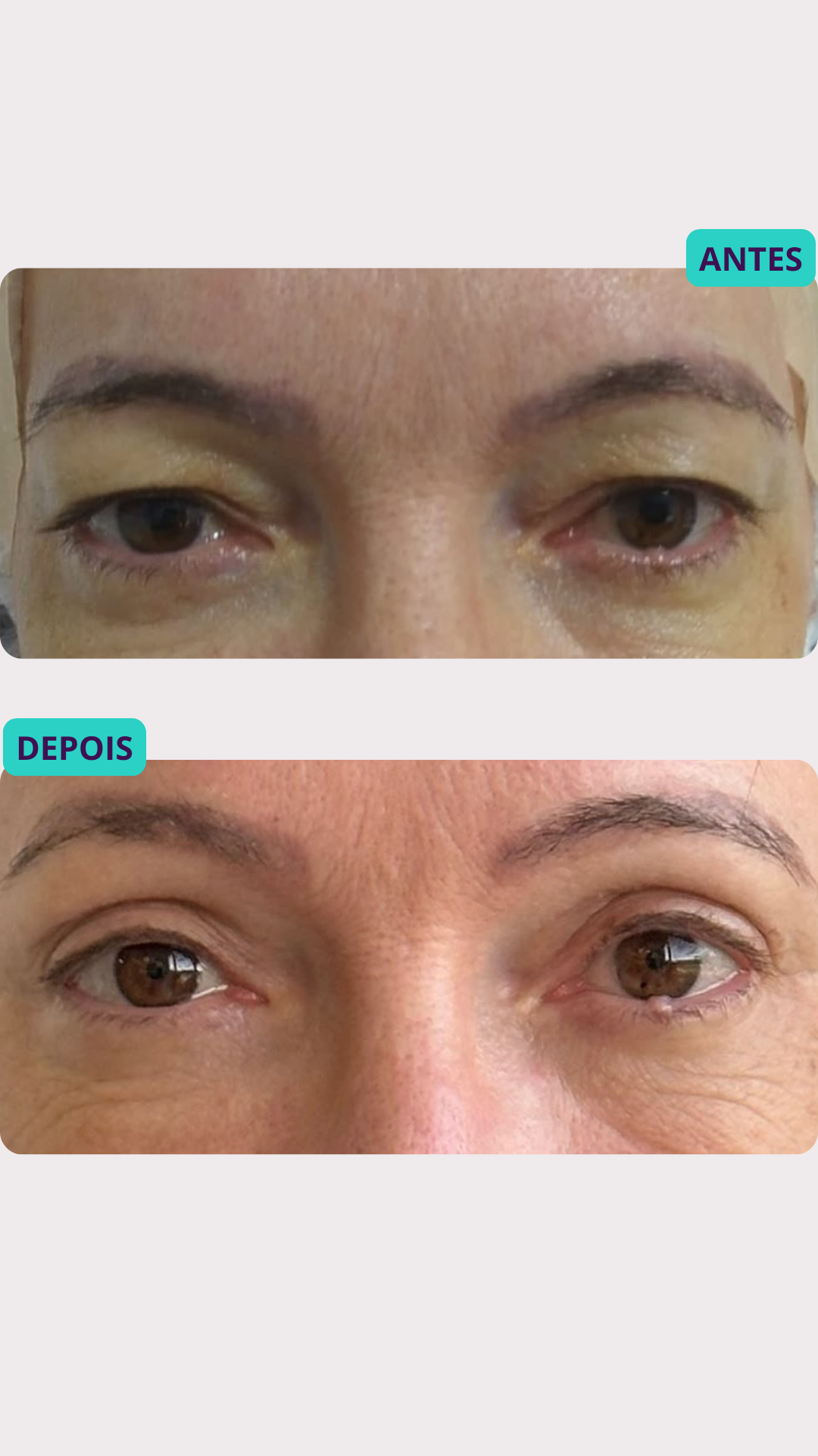 Blefaroplastia a Laser — antes e depois, paciente 5