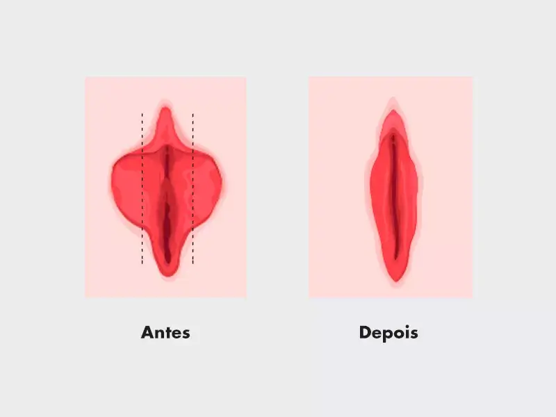 Ninfoplastia a Laser — resultado